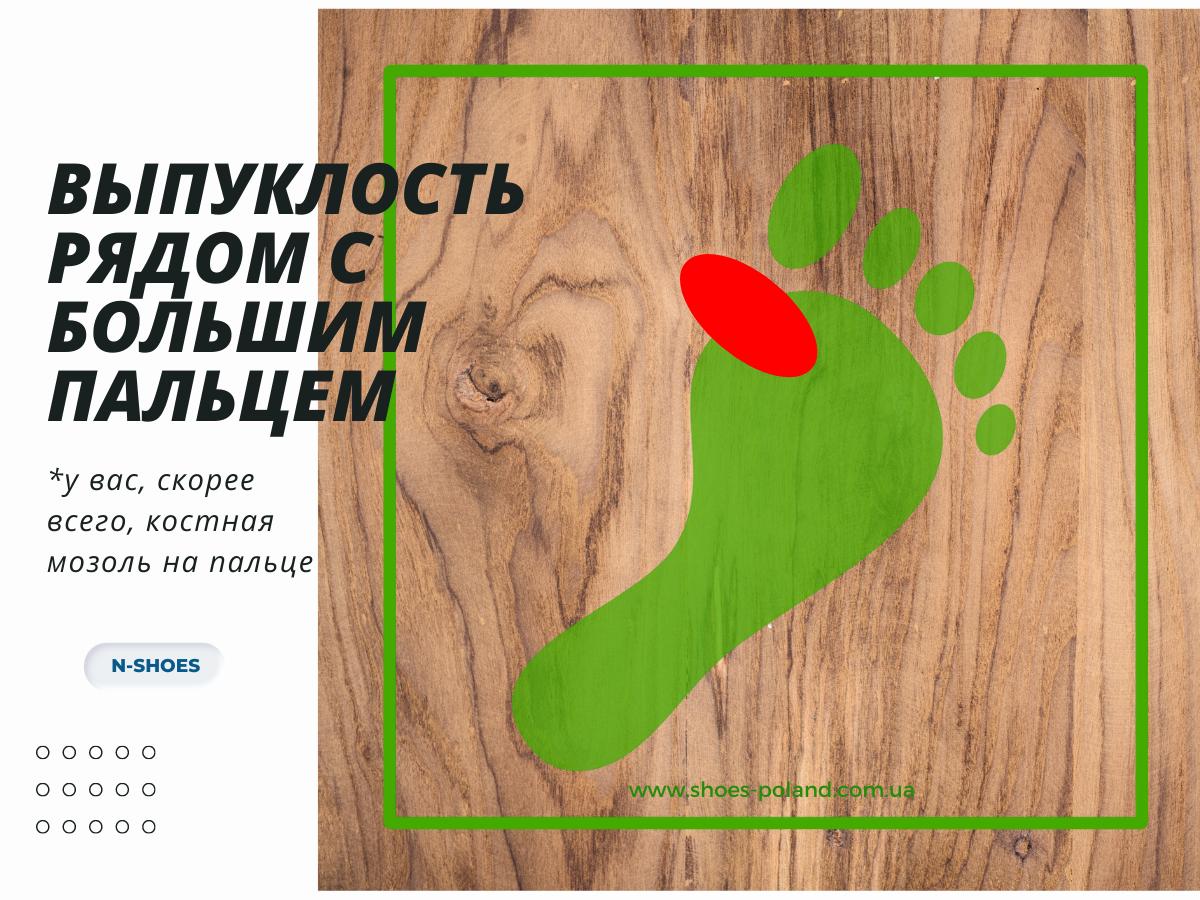 что означает износ обуви Выпуклость рядом с большим пальцем