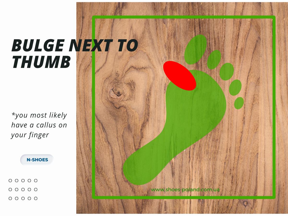 what does shoe wear mean Bulge next to the big toe